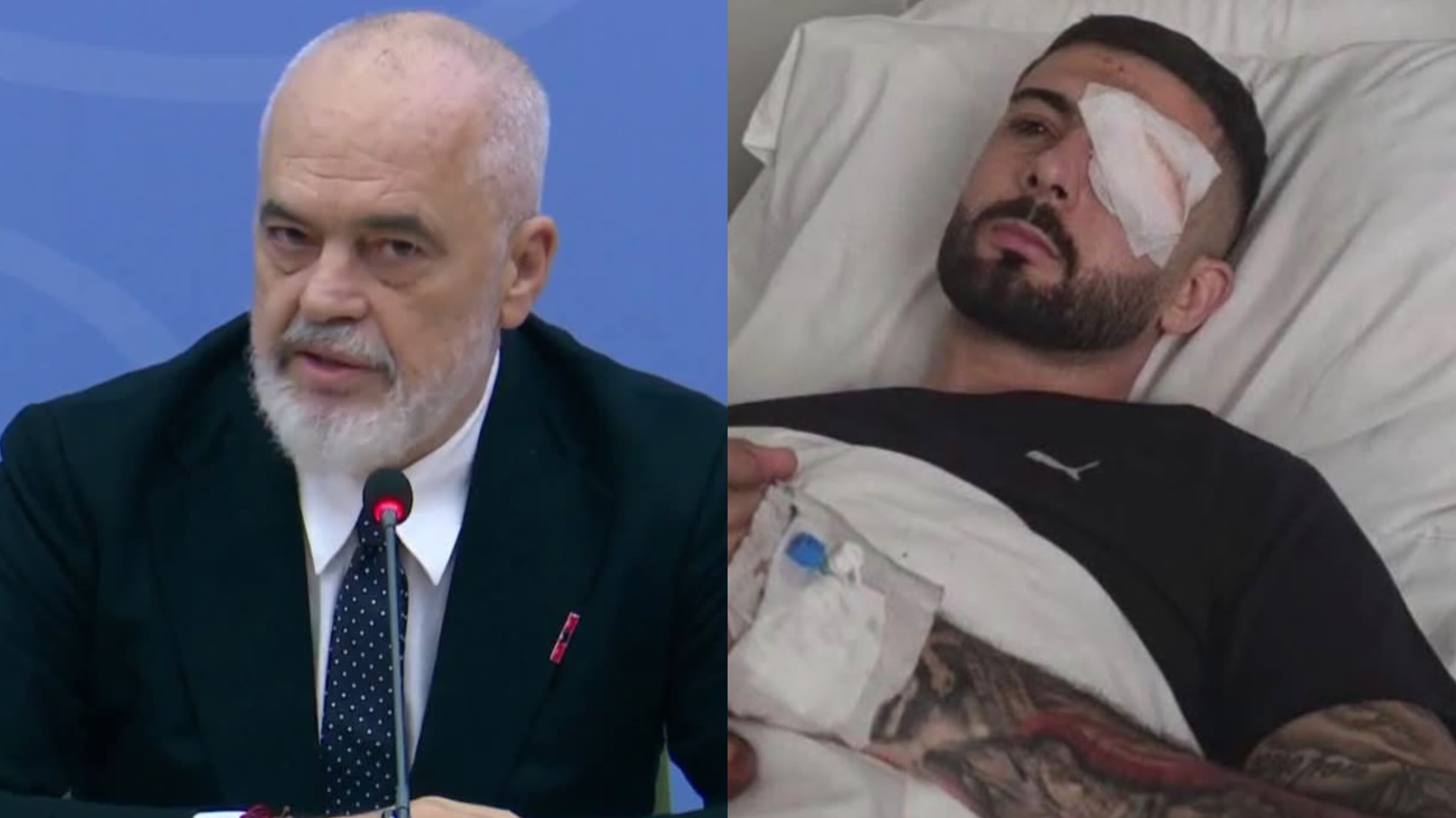 RAMA PËR TË RIUN QË U PLAGOS NË SY: U KUJDESA TË SHKOJË NË SPITALIN MË TË MIRË NË ITALI